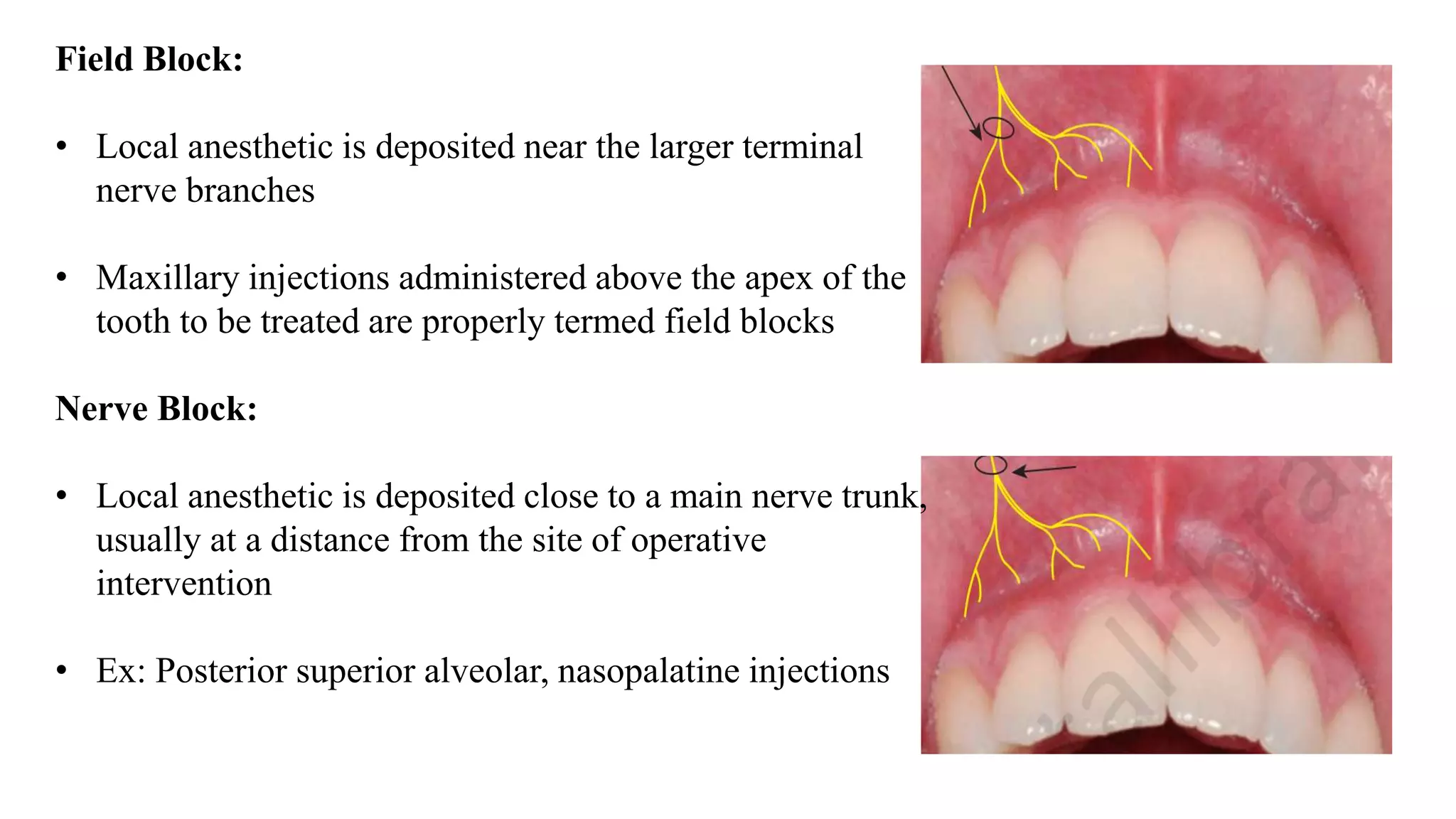 Field Block:
• Local anesthetic is deposited near the larger terminal
nerve branches
• Maxillary injections administered above the apex of the
tooth to be treated are properly termed field blocks
Nerve Block:
• Local anesthetic is deposited close to a main nerve trunk,
usually at a distance from the site of operative
intervention
• Ex: Posterior superior alveolar, nasopalatine injections
 