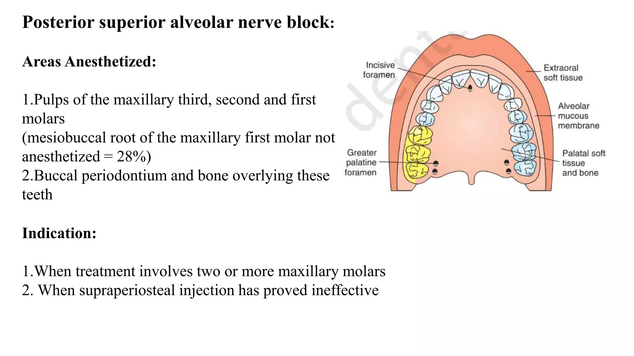 Posterior superior alveolar nerve block:
Areas Anesthetized:
1.Pulps of the maxillary third, second and first
molars
(mesiobuccal root of the maxillary first molar not
anesthetized = 28%)
2.Buccal periodontium and bone overlying these
teeth
Indication:
1.When treatment involves two or more maxillary molars
2. When supraperiosteal injection has proved ineffective
 