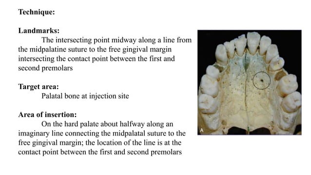 Maxillary nerve block | PPTX