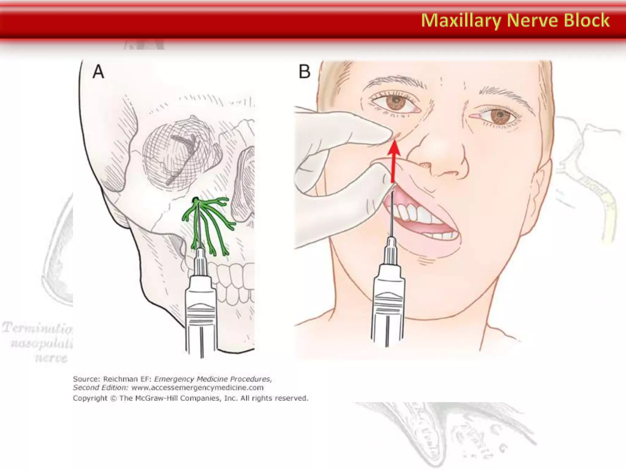 maxillary-nerve-block-pptx