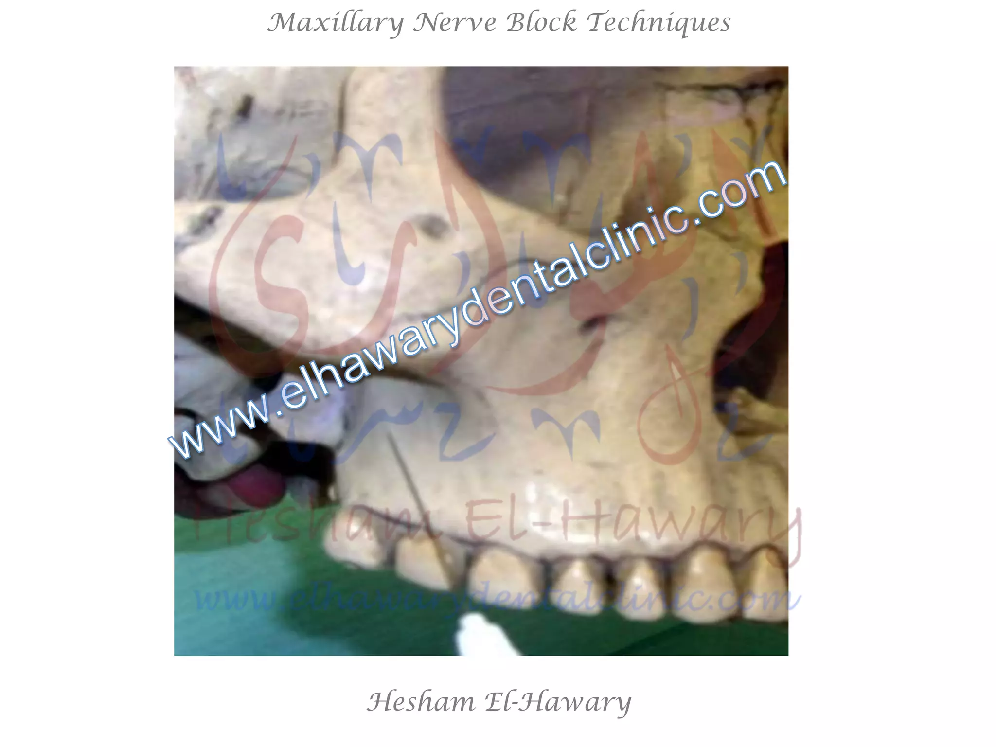 Hesham El-Hawary
Maxillary Nerve Block Techniques
 