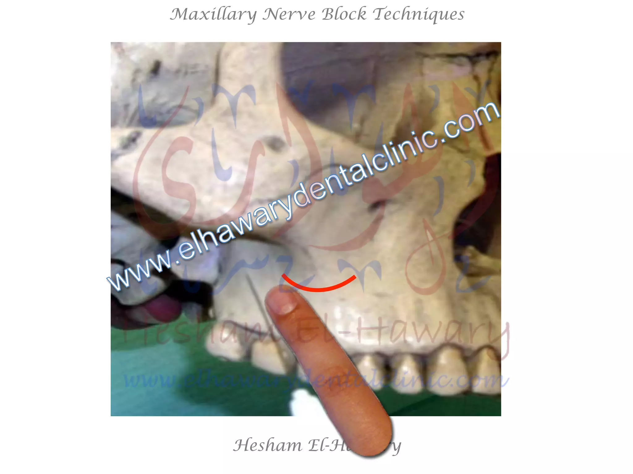 Hesham El-Hawary
Maxillary Nerve Block Techniques
 