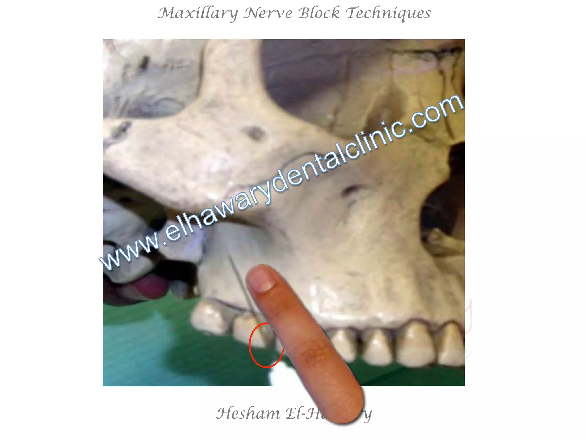 Hesham El-Hawary
Maxillary Nerve Block Techniques
 