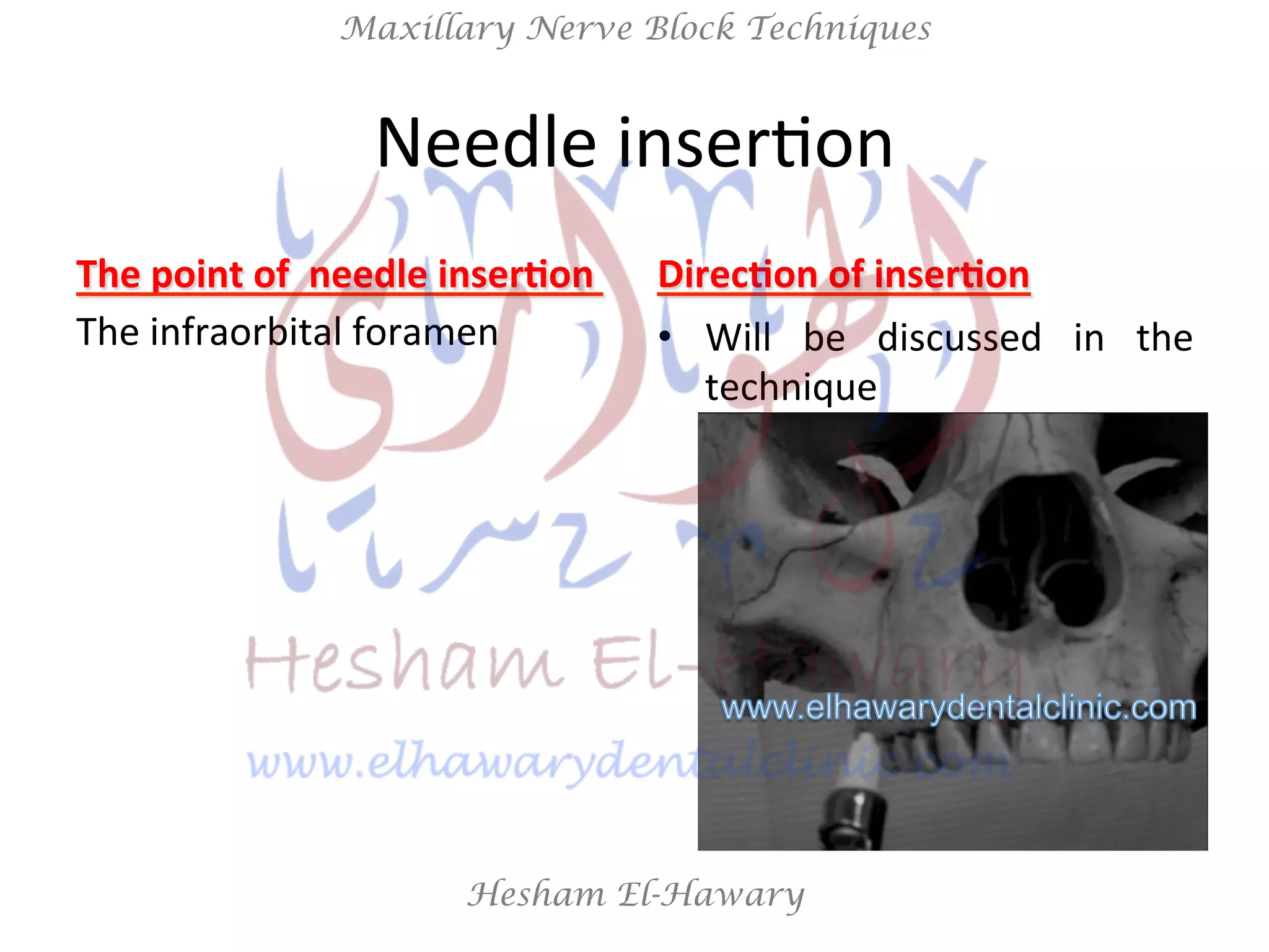 Hesham El-Hawary
Maxillary Nerve Block Techniques
Needle	
  inserNon	
  
The	
  point	
  of	
  	
  needle	
  inser/on	
  	
  
The	
  infraorbital	
  foramen	
  
	
  
Direc/on	
  of	
  inser/on	
  
•  Will	
   be	
   discussed	
   in	
   the	
  
technique	
  
 