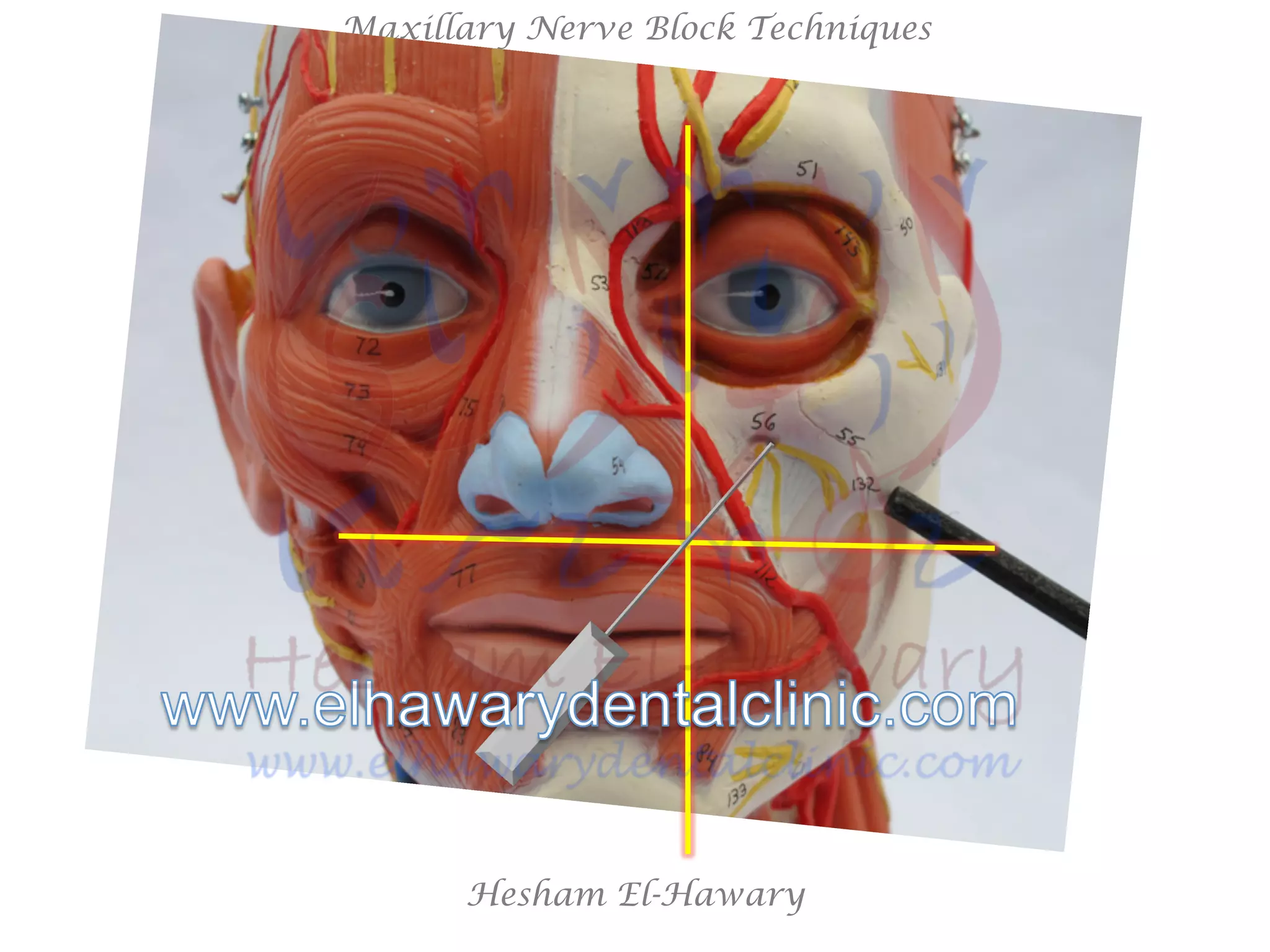 Hesham El-Hawary
Maxillary Nerve Block Techniques
 
