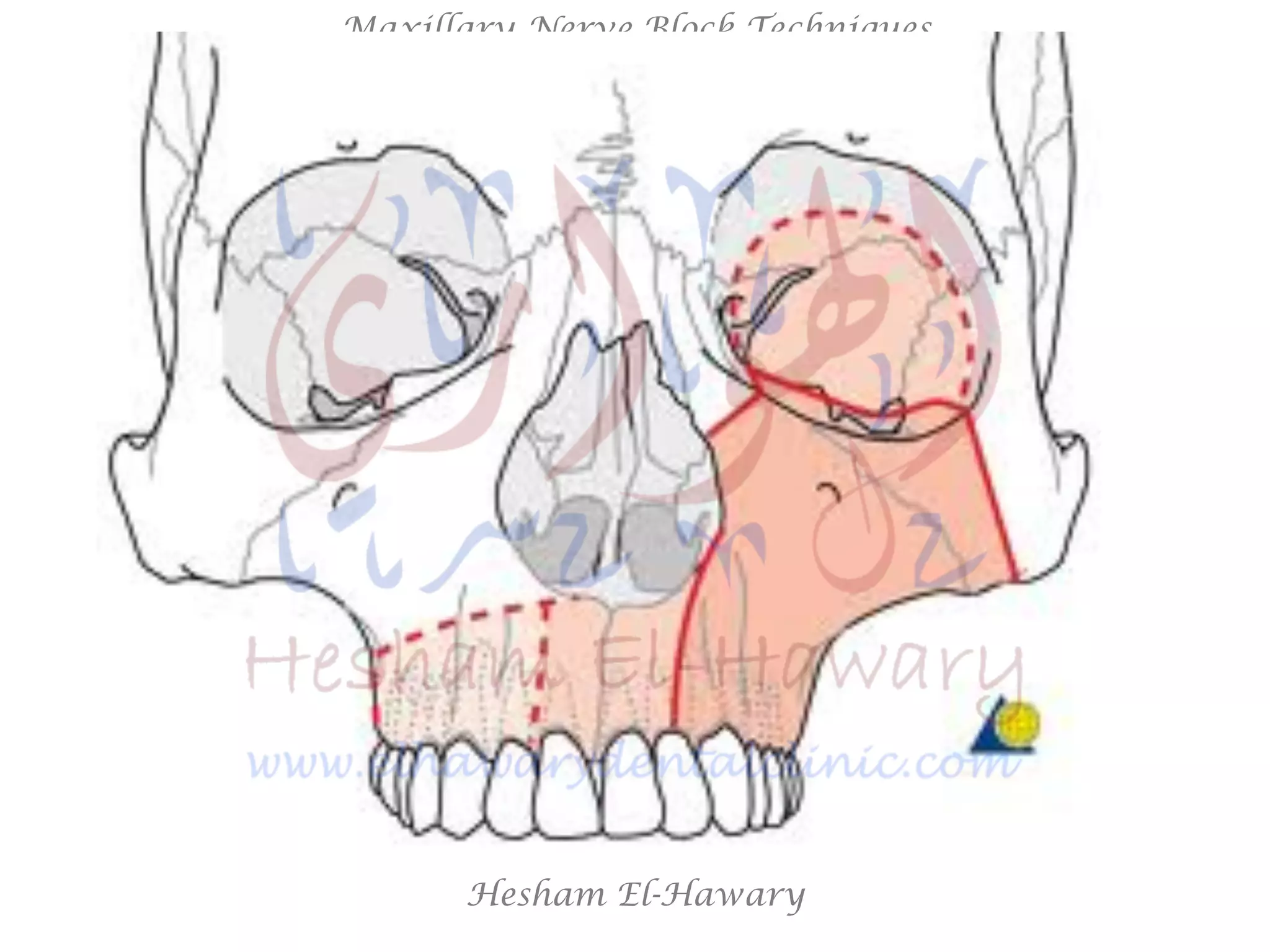 Hesham El-Hawary
Maxillary Nerve Block Techniques
 