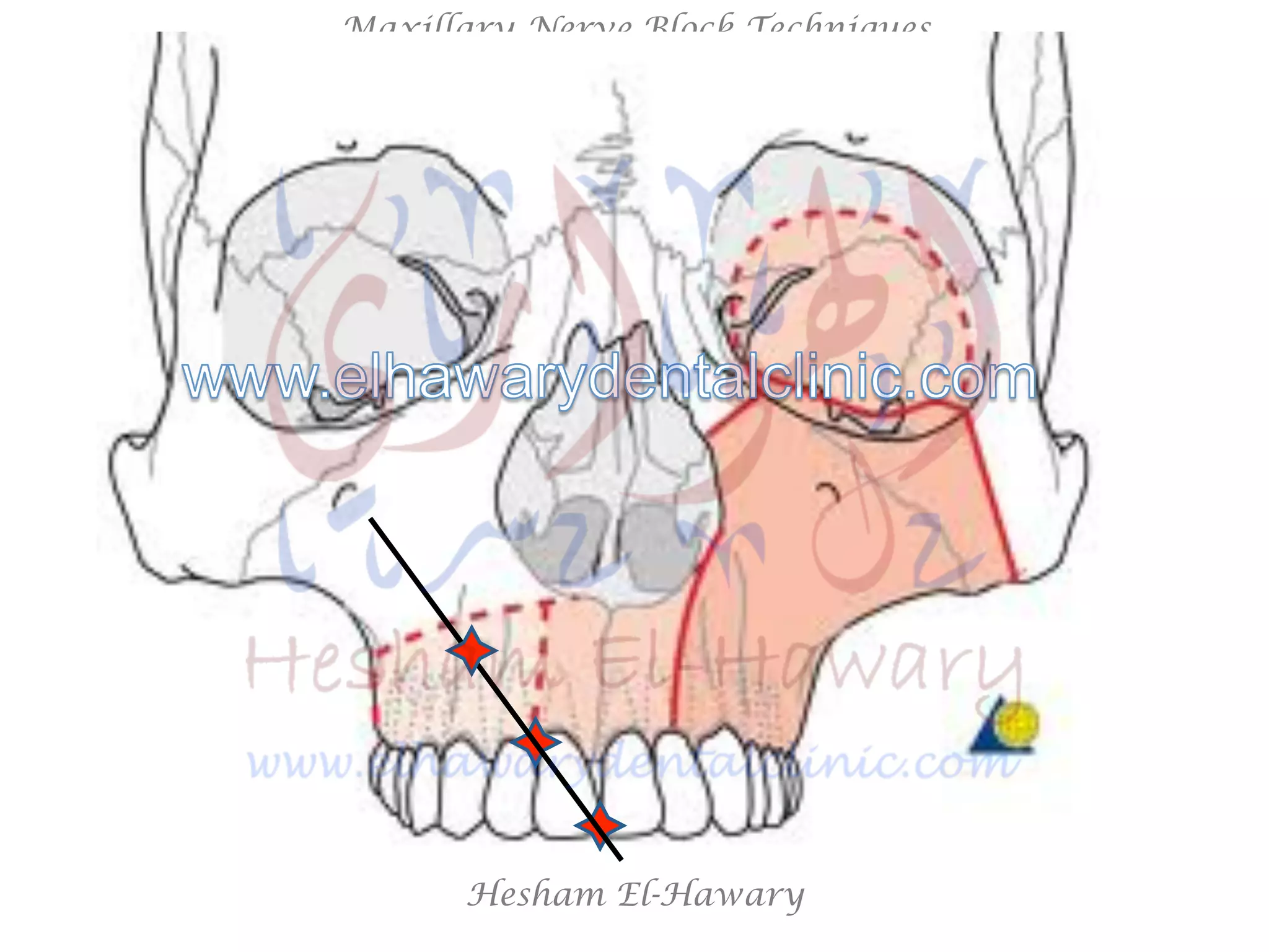 Hesham El-Hawary
Maxillary Nerve Block Techniques
 