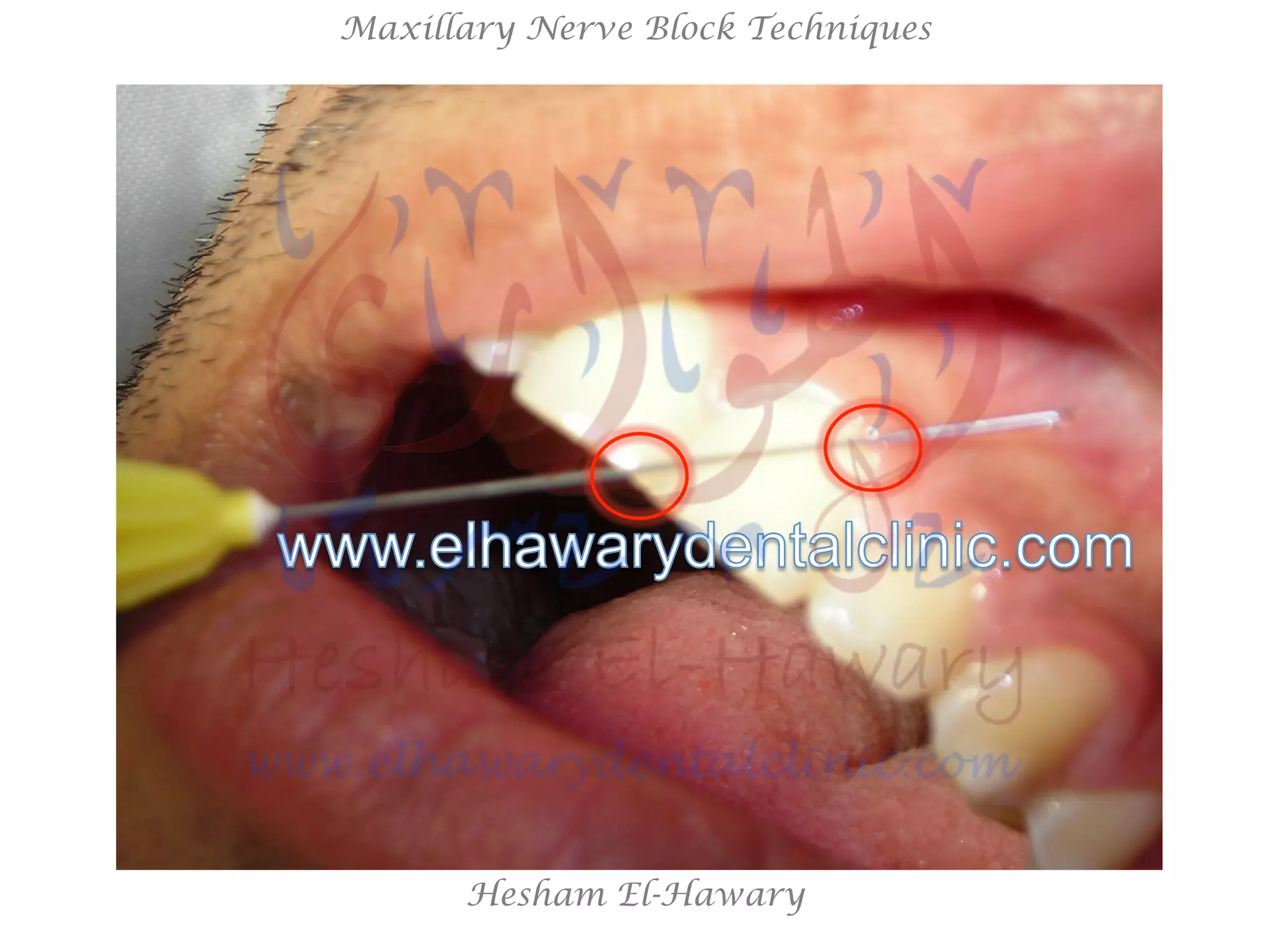 Hesham El-Hawary
Maxillary Nerve Block Techniques
 