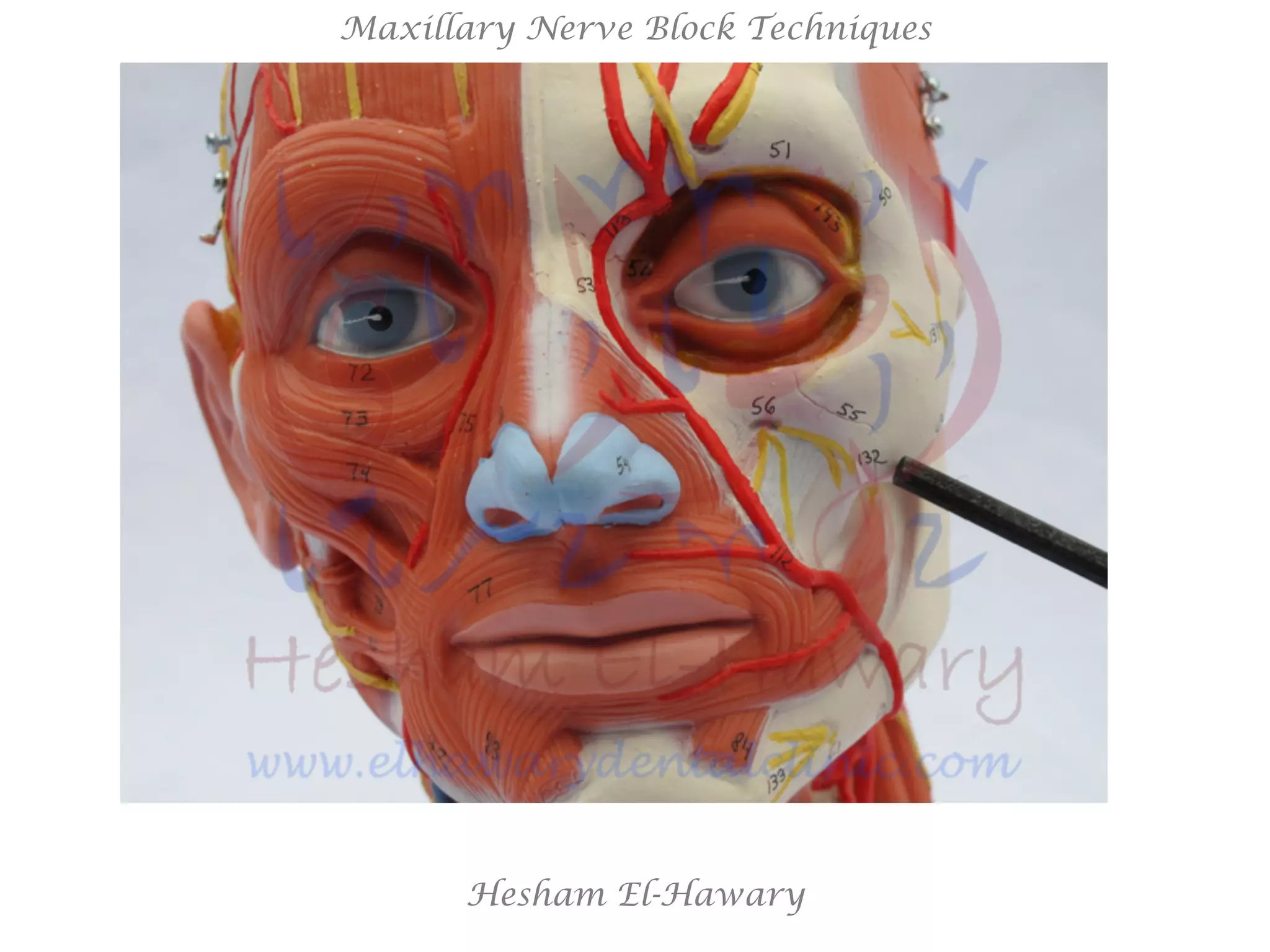 Hesham El-Hawary
Maxillary Nerve Block Techniques
 