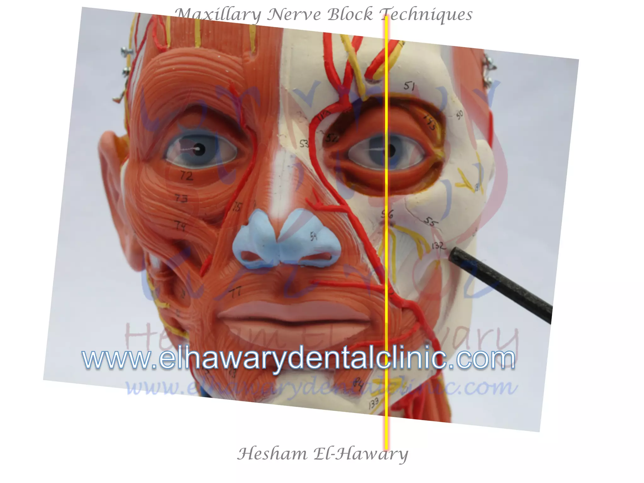 Hesham El-Hawary
Maxillary Nerve Block Techniques
 