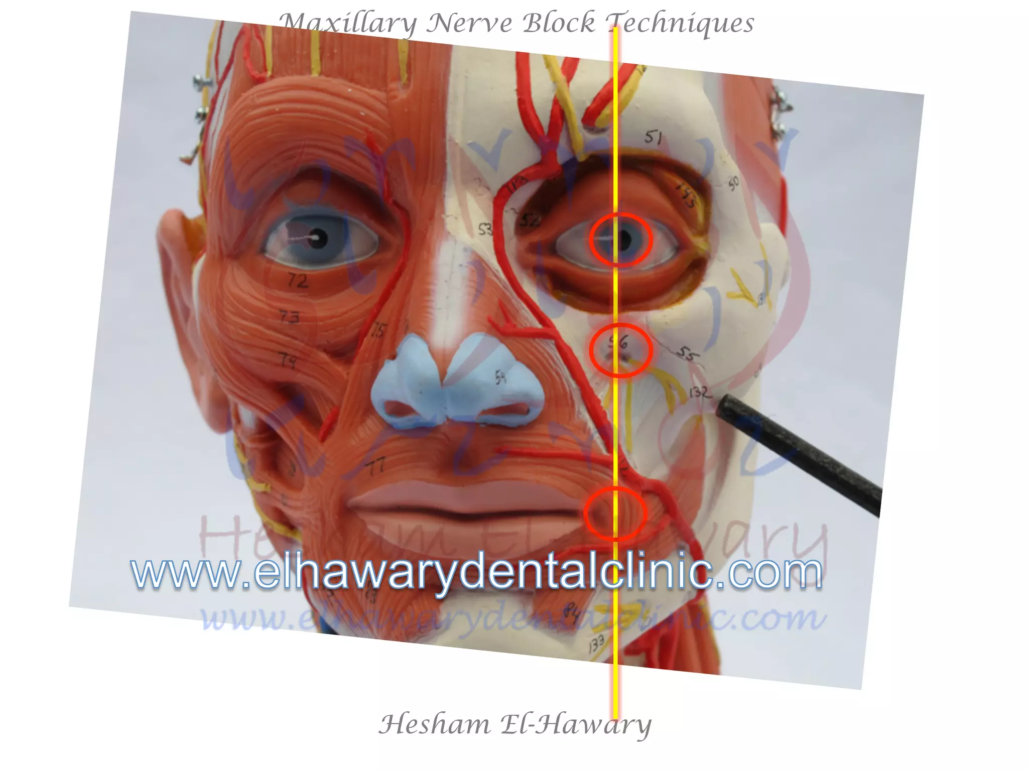 Hesham El-Hawary
Maxillary Nerve Block Techniques
 