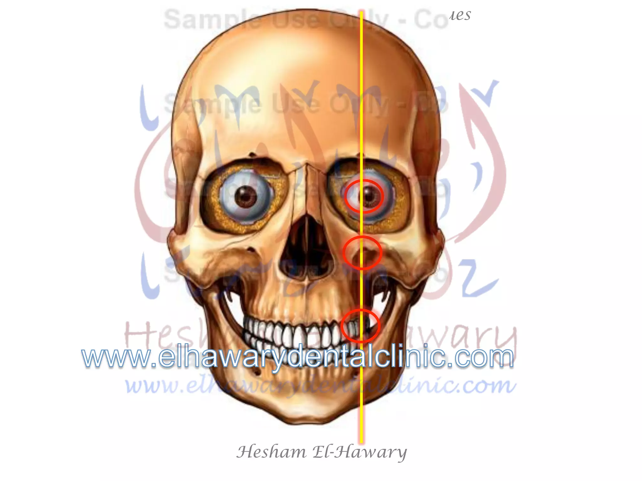 Hesham El-Hawary
Maxillary Nerve Block Techniques
 