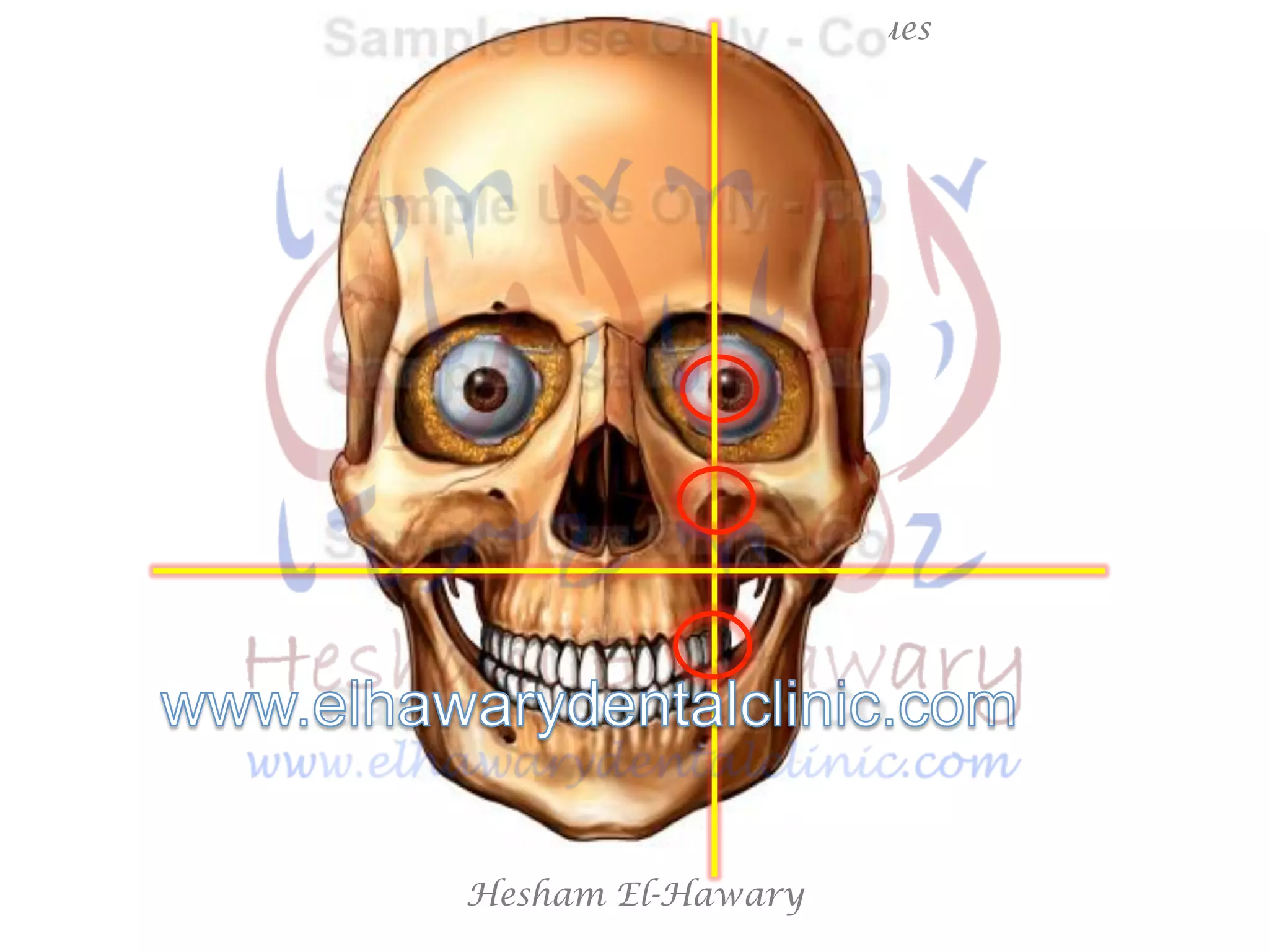 Hesham El-Hawary
Maxillary Nerve Block Techniques
 