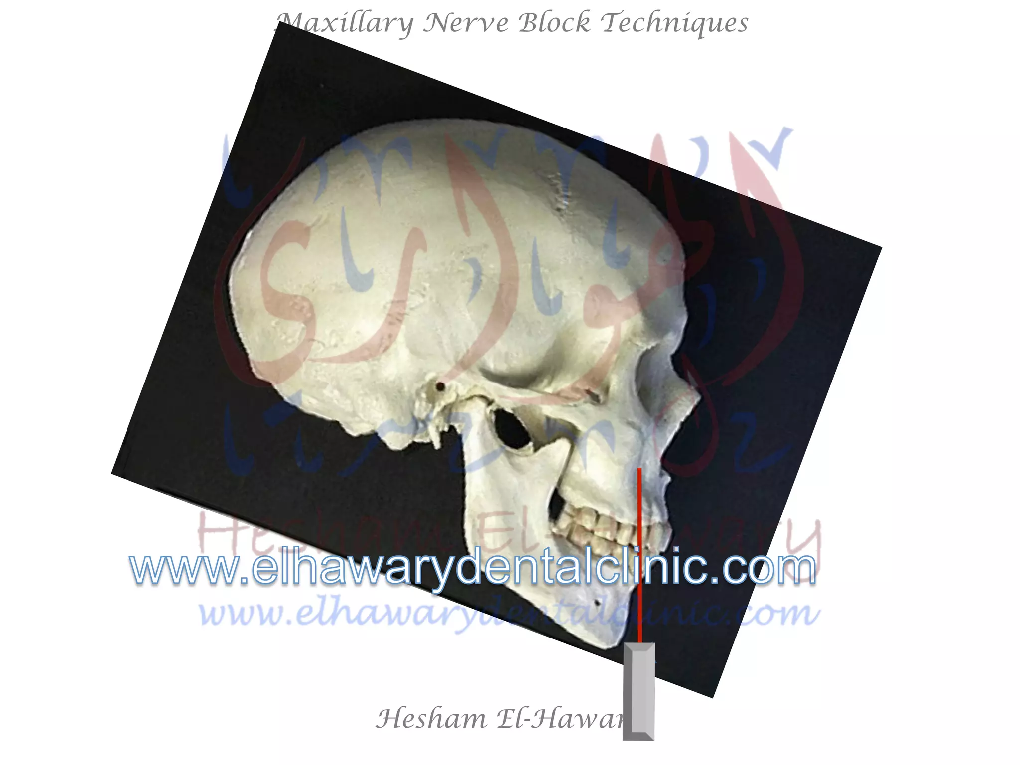 Hesham El-Hawary
Maxillary Nerve Block Techniques
 