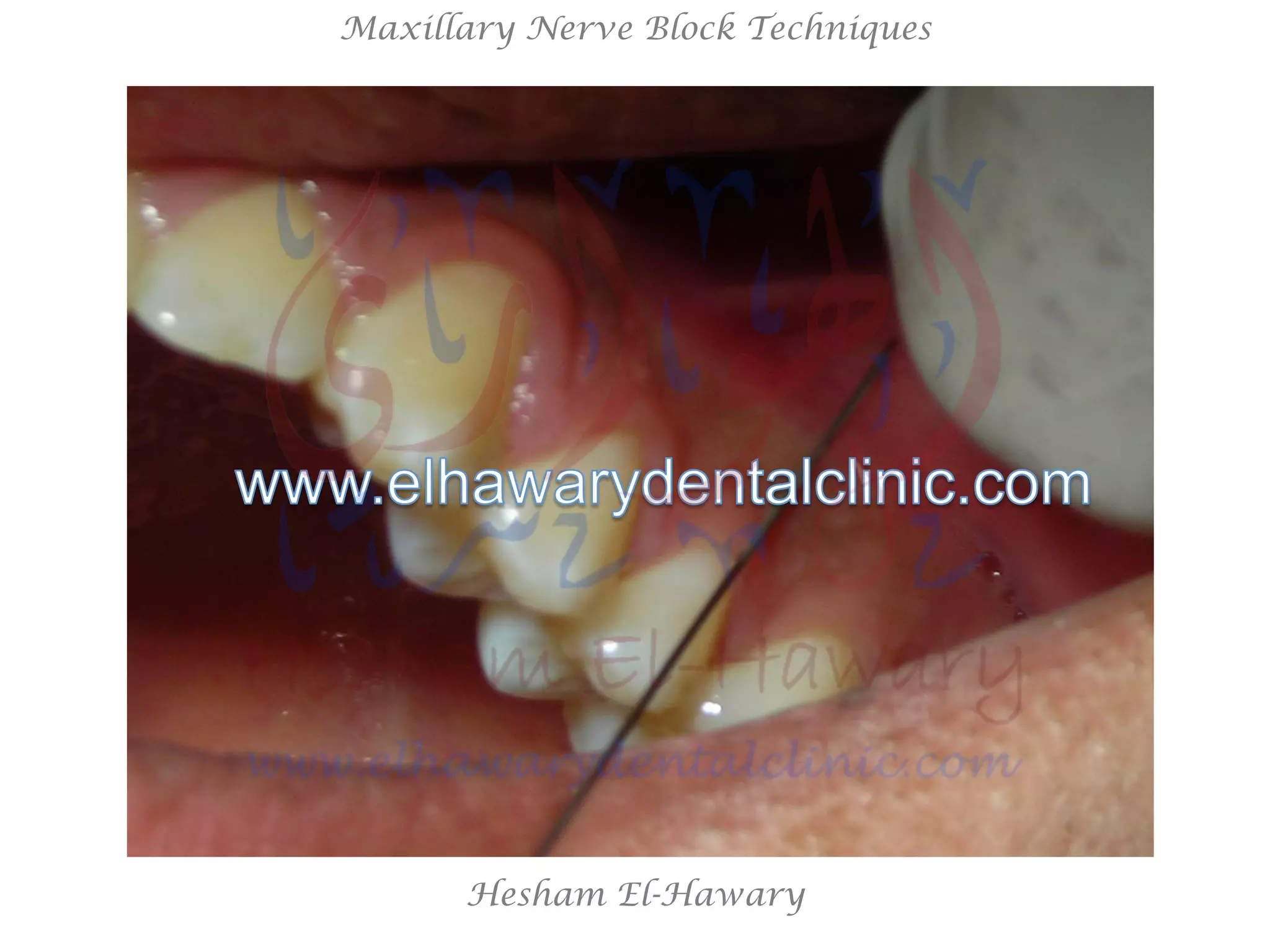 Hesham El-Hawary
Maxillary Nerve Block Techniques
 