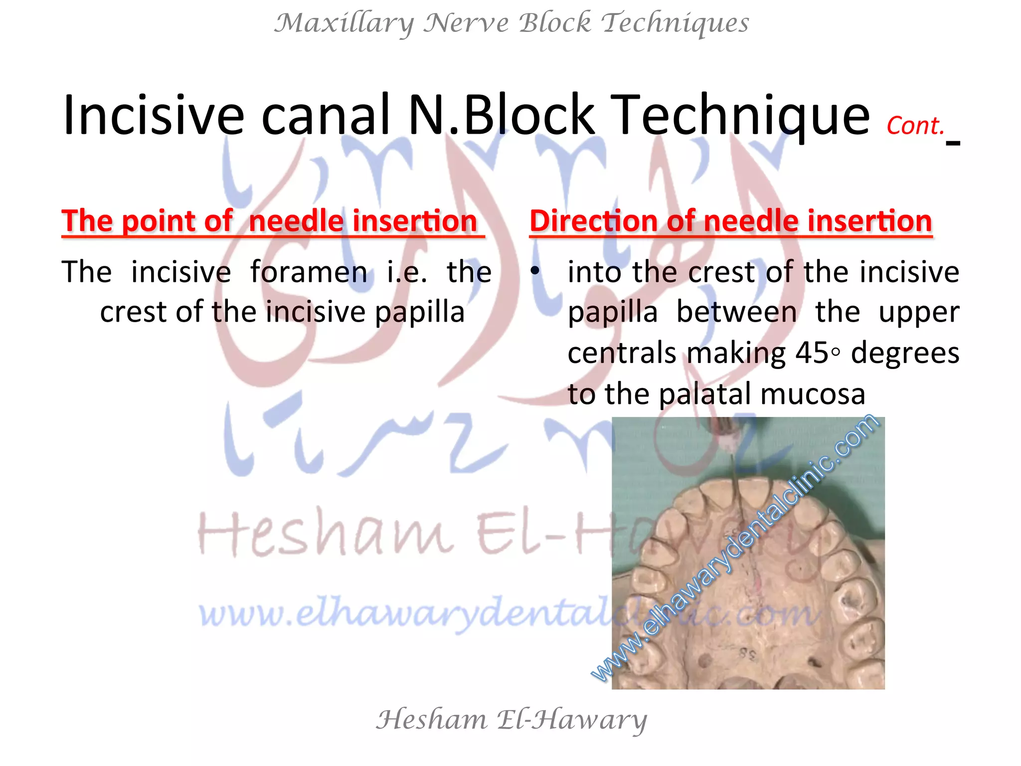 Hesham El-Hawary
Maxillary Nerve Block Techniques
Incisive	
  canal	
  N.Block	
  Technique	
  Cont.	
  	
  
The	
  point	
  of	
  	
  needle	
  inser/on	
  	
  
The	
   incisive	
   foramen	
   i.e.	
   the	
  
crest	
  of	
  the	
  incisive	
  papilla	
  
	
  
Direc/on	
  of	
  needle	
  inser/on	
  
•  into	
  the	
  crest	
  of	
  the	
  incisive	
  
papilla	
   between	
   the	
   upper	
  
centrals	
  making	
  45◦	
  degrees	
  
to	
  the	
  palatal	
  mucosa	
  
	
  
 