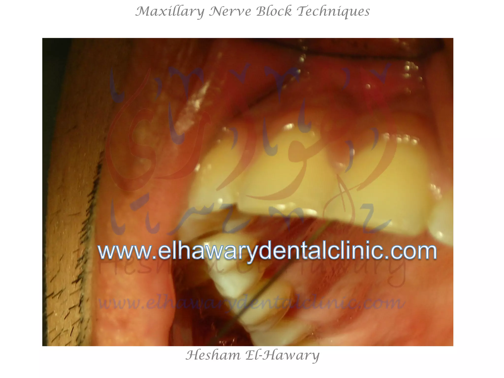 Hesham El-Hawary
Maxillary Nerve Block Techniques
 