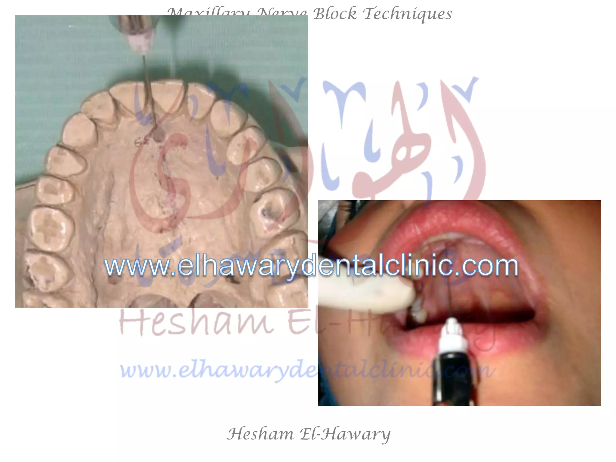 Hesham El-Hawary
Maxillary Nerve Block Techniques
 