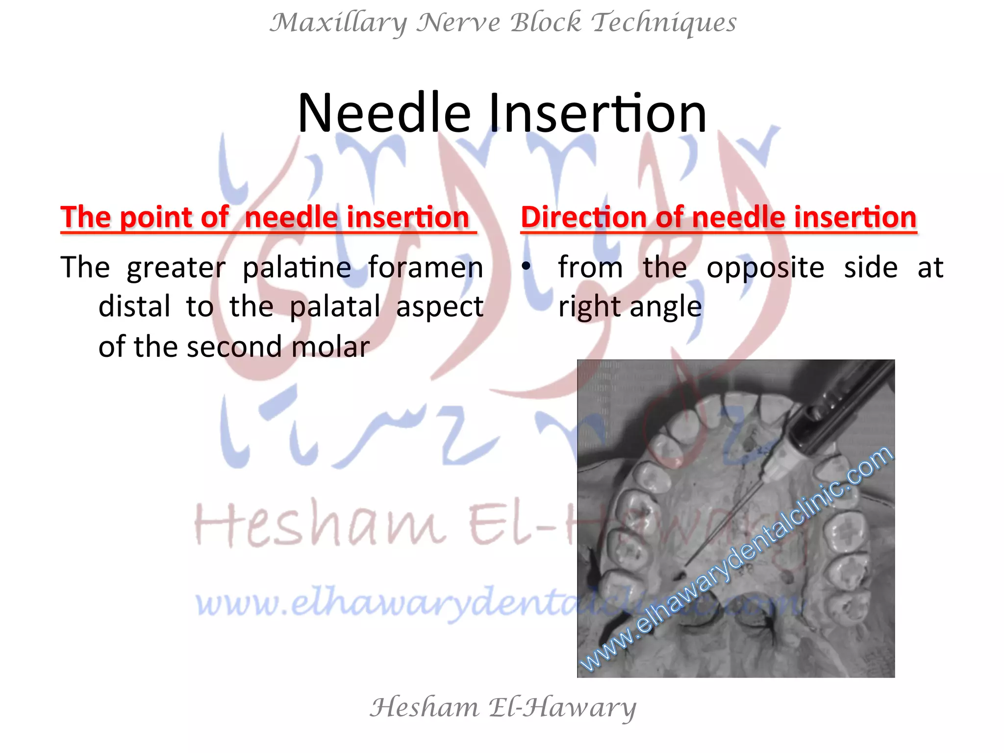 Hesham El-Hawary
Maxillary Nerve Block Techniques
Needle	
  InserNon	
  
The	
  point	
  of	
  	
  needle	
  inser/on	
  	
  
The	
   greater	
   palaNne	
   foramen	
  
distal	
   to	
   the	
   palatal	
   aspect	
  
of	
  the	
  second	
  molar	
  
Direc/on	
  of	
  needle	
  inser/on	
  
•  from	
   the	
   opposite	
   side	
   at	
  
right	
  angle	
  
 