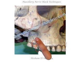 Hesham El-Hawary
Maxillary Nerve Block Techniques
 