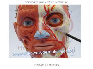 Hesham El-Hawary
Maxillary Nerve Block Techniques
 
