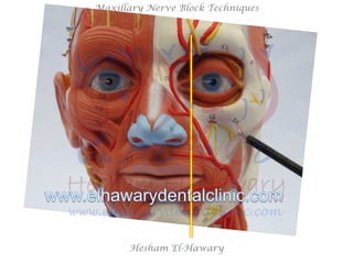 Hesham El-Hawary
Maxillary Nerve Block Techniques
 