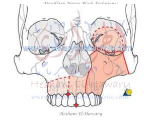 Hesham El-Hawary
Maxillary Nerve Block Techniques
 