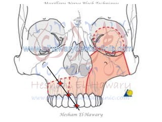 Hesham El-Hawary
Maxillary Nerve Block Techniques
 