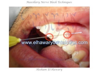 Hesham El-Hawary
Maxillary Nerve Block Techniques
 