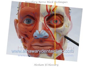 Hesham El-Hawary
Maxillary Nerve Block Techniques
 