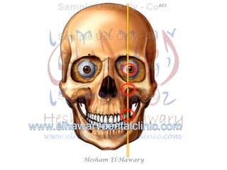 Hesham El-Hawary
Maxillary Nerve Block Techniques
 