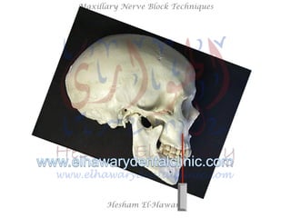 Hesham El-Hawary
Maxillary Nerve Block Techniques
 