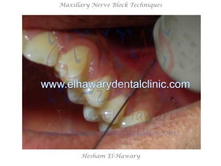 Hesham El-Hawary
Maxillary Nerve Block Techniques
 