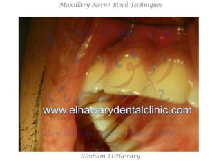 Hesham El-Hawary
Maxillary Nerve Block Techniques
 