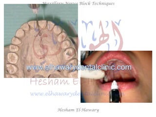 Hesham El-Hawary
Maxillary Nerve Block Techniques
 