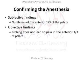 Hesham El-Hawary
Maxillary Nerve Block Techniques
Conﬁrming	
  the	
  Anesthesia	
  
•  SubjecNve	
  ﬁndings	
  
– Numbness	
  of	
  the	
  anterior	
  1/3	
  of	
  the	
  palate	
  
•  ObjecNve	
  ﬁndings	
  	
  
– Probing	
  does	
  not	
  lead	
  to	
  pain	
  in	
  the	
  anterior	
  1/3	
  
of	
  palate	
  
 