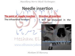 Hesham El-Hawary
Maxillary Nerve Block Techniques
Needle	
  inserNon	
  
The	
  point	
  of	
  	
  needle	
  inser/on	
  	...