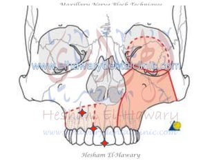 Hesham El-Hawary
Maxillary Nerve Block Techniques
 