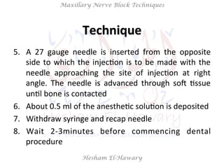 Hesham El-Hawary
Maxillary Nerve Block Techniques
5.  A	
   27	
   gauge	
   needle	
   is	
   inserted	
   from	
   the	
...