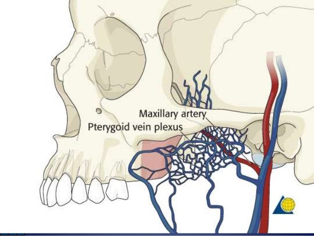 lefort osteotomies