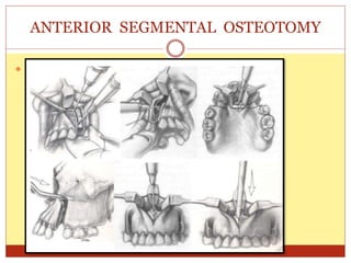  WASSMUND TECHNIQUE:
ANTERIOR SEGMENTAL OSTEOTOMY
 