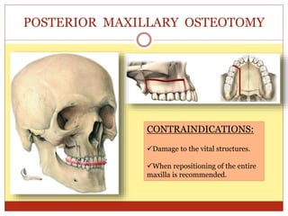 POSTERIOR MAXILLARY OSTEOTOMY
CONTRAINDICATIONS:
Damage to the vital structures.
When repositioning of the entire
maxilla is recommended.
 