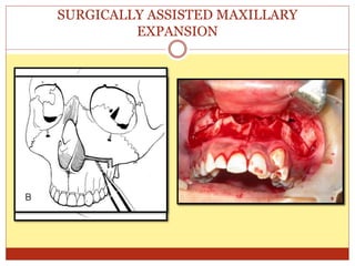 SURGICALLY ASSISTED MAXILLARY
EXPANSION
 