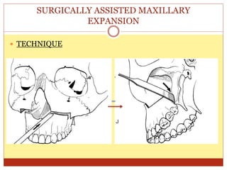 SURGICALLY ASSISTED MAXILLARY
EXPANSION
 TECHNIQUE
 
