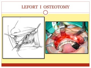 LEFORT I OSTEOTOMY
 