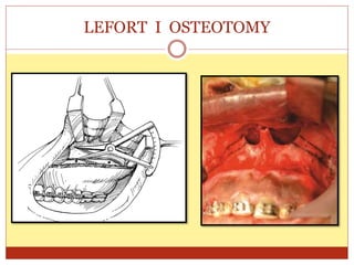 LEFORT I OSTEOTOMY
 