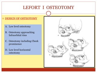 LEFORT I OSTEOTOMY
 DESIGN OF OSTEOTOMY
A. Low level osteotomy
B. Osteotomy approaching
Infraorbital rims
C. Osteotomy including Cheek
prominence
D. Low level horizontal
osteotomy
 