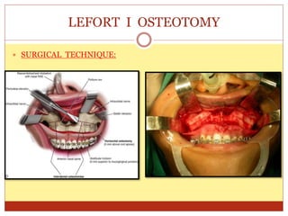 LEFORT I OSTEOTOMY
 SURGICAL TECHNIQUE:
 