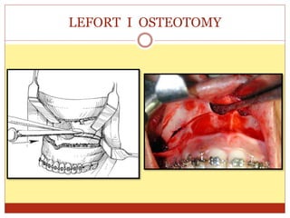 LEFORT I OSTEOTOMY
 