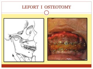 LEFORT I OSTEOTOMY
 